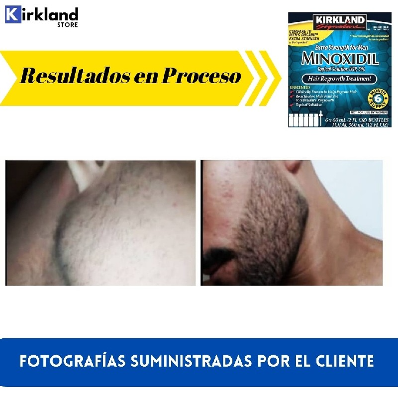 Minoxidil Kirkland 5% Americano Und