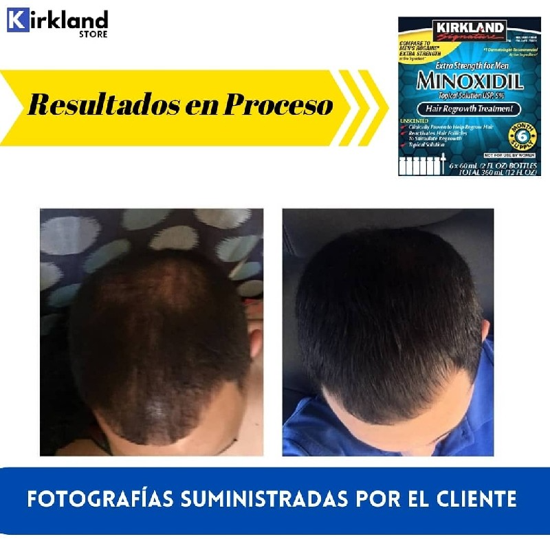 Minoxidil Kirkland 5% Americano Und