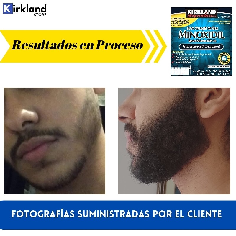 Minoxidil Kirkland 5% Americano Und